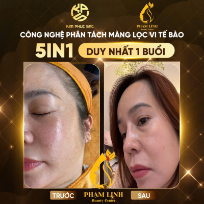 Chăm sóc da tàn nhang